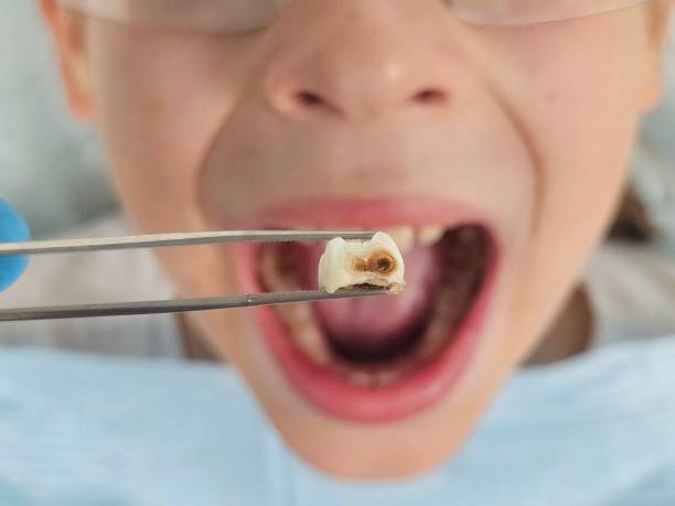 Best Emergency Treatment for Dental Infections or Abscesses in Emerd Mountain, AL