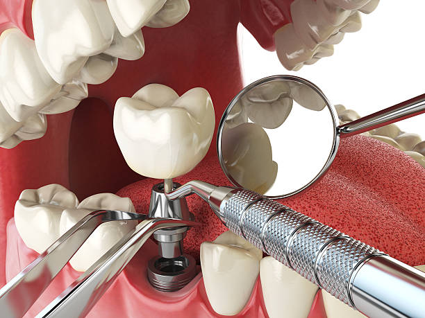 Best Emergency Denture Repair in Emerd Mountain, AL